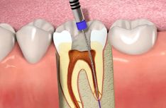 Endodontija