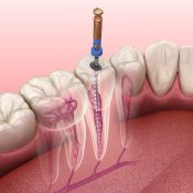 Dantų implantacija