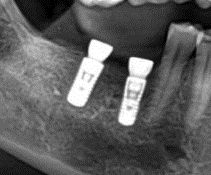 Dantų implantacija, burnos chirurgija
