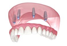 Viso žandikaulio atstatymas ant 4 implantų + nemokama inhaliacinė sedacija