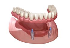 Išimamas dantų protezas ant 2 implantų + nemokama inhaliacinė sedacija