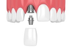 Pilnas danties atstatymas ant implanto + nemokama inhaliacinė sedacija