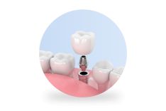 DANTŲ IMPLANTACIJA