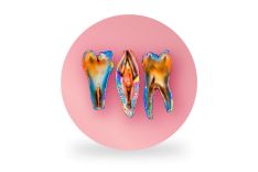 ENDODONTIJA - DANTŲ ŠAKNŲ KANALŲ GYDYMAS