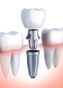 Dantų implantacija