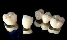 Metalo keramikos dantų protezai
