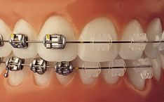 Ortodontija, breketai