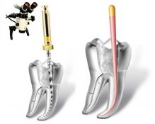 Endodontinis gydymas naudojant mikroskopą