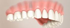 Dantų implantai