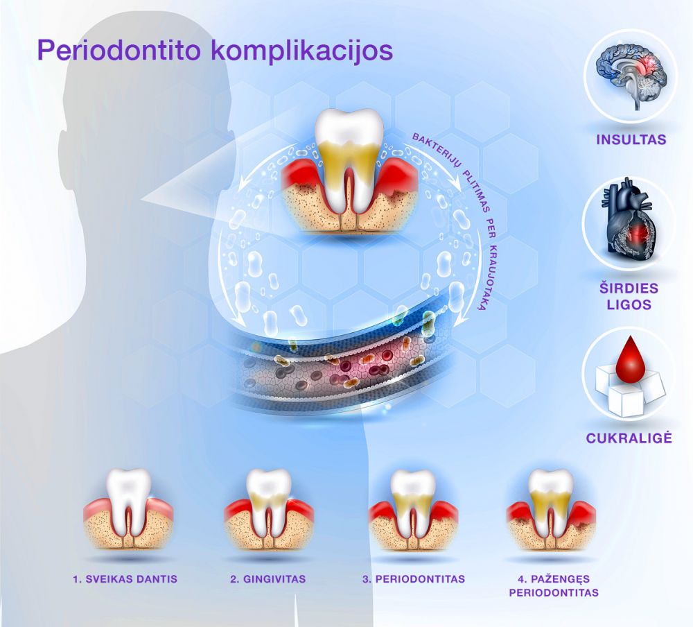 periodontito komplikacijos