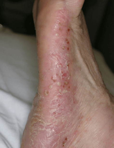 Pustulinė psoriazė