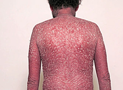 Eritroderminė psoriazė