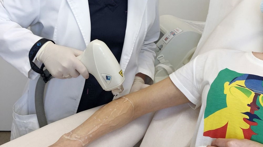 Nepageidaujamus plaukelius lazeriu šalink net ir vasarą Nepageidaujamus plaukelius lazeriu šalink net ir vasarą