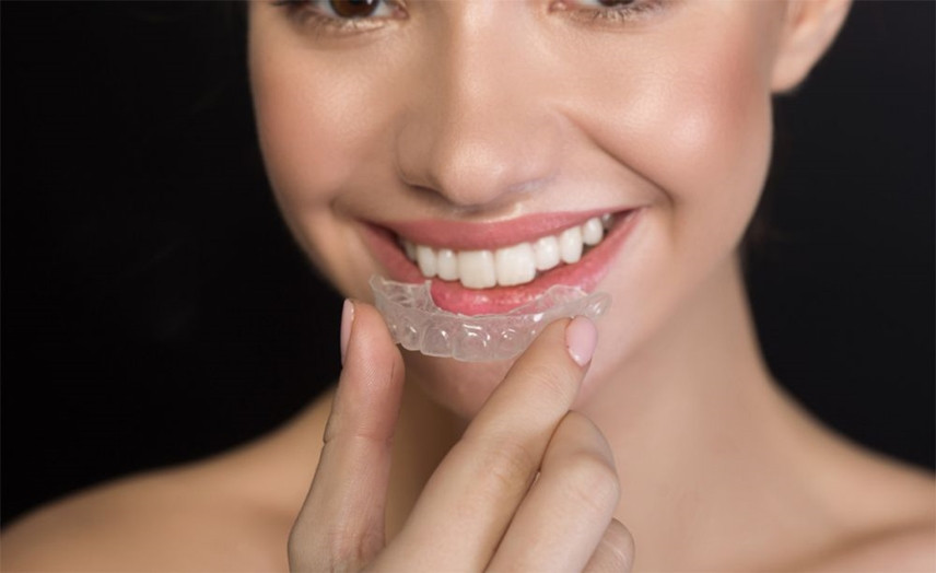 Dantų tiesinimas kapomis - nematomas gydymas ir akivaizdus rezultatas