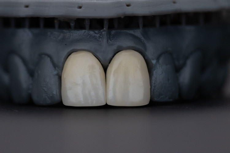Koks dantų implantas geriausias? Ką rinktis?