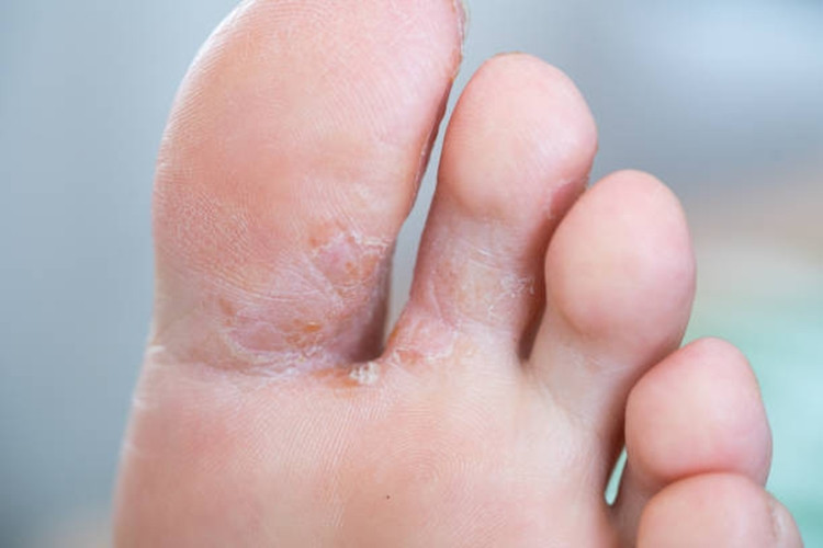 Sportininko pėda (Tinea Pedis) – kas tai?