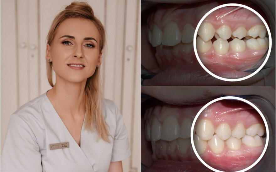 Specialistė perspėjo, kodėl nereikėtų atidėti dantų tiesinimo procedūros