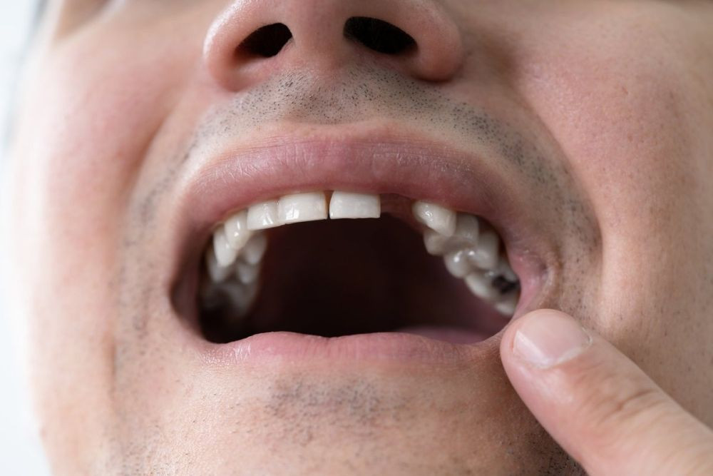 Kaip vieno danties praradimas sukelia domino efektą: gydytoja įspėja problemas šalinti kuo greičiau