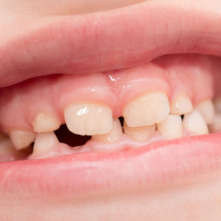 Pieninių dantų ortodontinis gydymas. Ar verta?