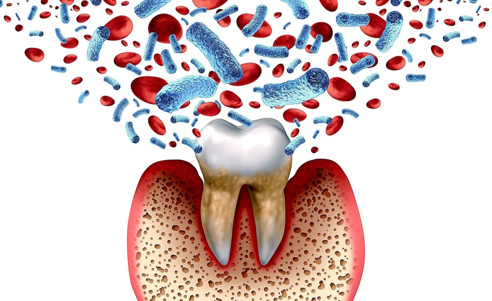 Alzheimerio liga – periodontito komplikacija?
