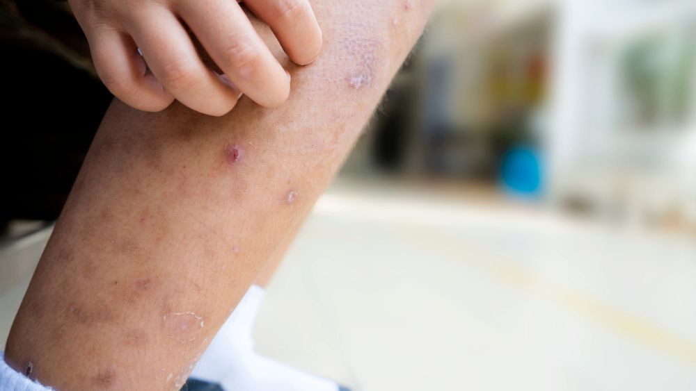 Blusų įkandimai: kaip atpažinti ir valdyti niežulį
