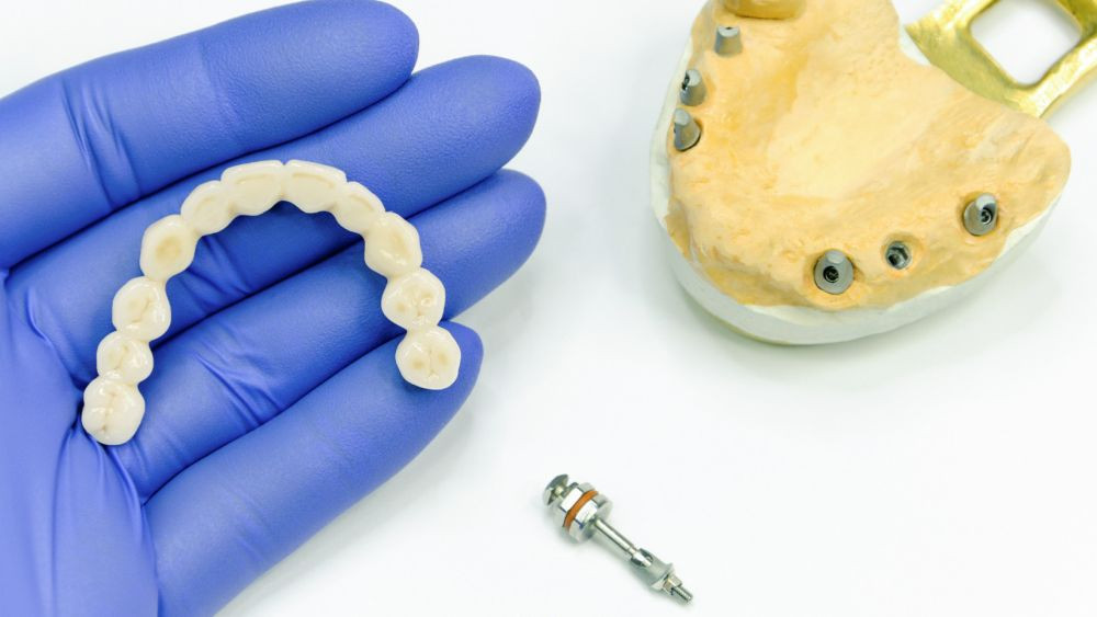 Pasirinkimas tarp tiltų ir implantų - ką turėtumėte žinoti