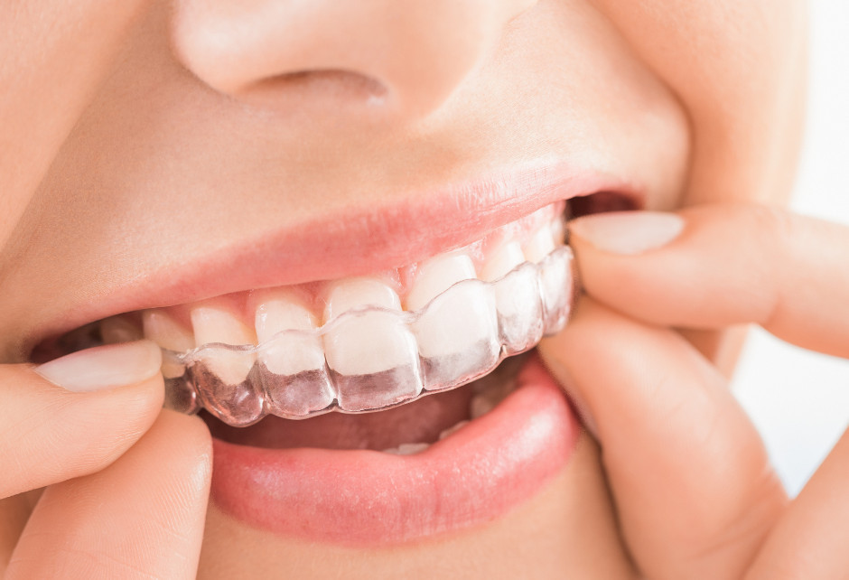 Naujos kartos dantų tiesinimas kapomis:  estetika ir komfortas siekiant nepriekaištingos šypsenos